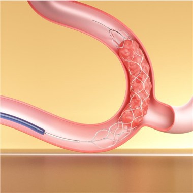 Stent Retriever Trombektomy Devices