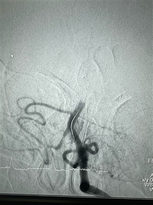 Nové pouzdro pro bagrovací stent retriever